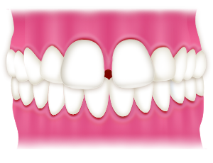 空隙歯列・正中離開