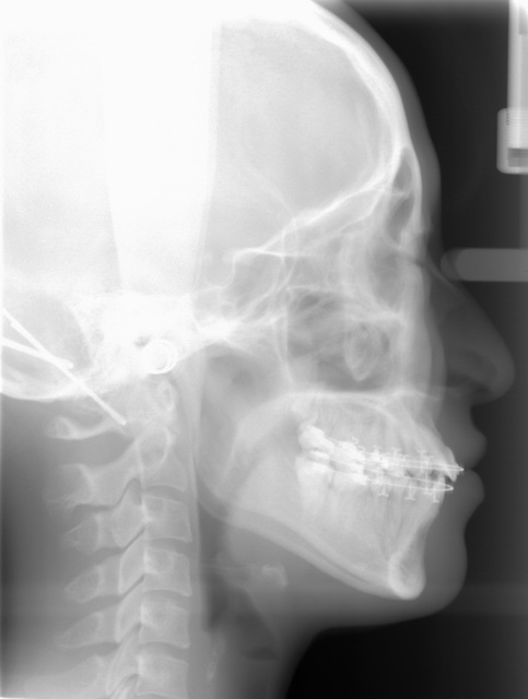 セファロレントゲン（頭部X線規格写真）