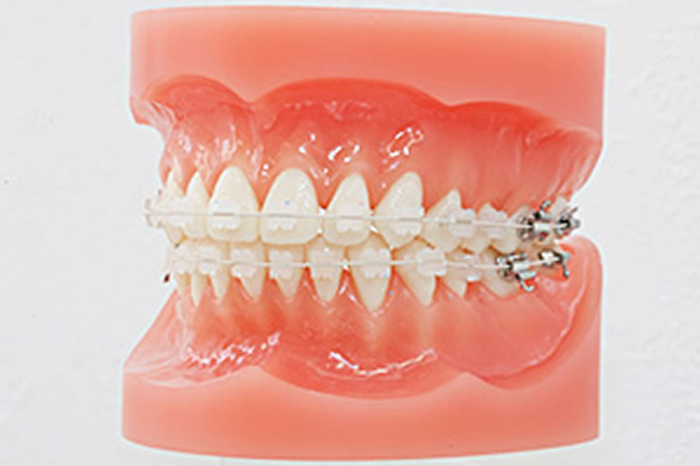 セルフライゲーションブラケットについて