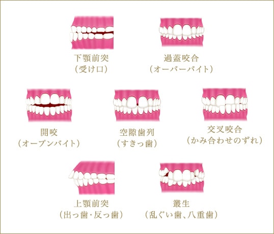 不正咬合の種類